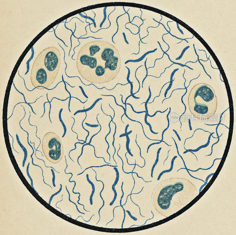 一个坏疽性口炎患者螺旋体螺旋体细菌的显微镜观察，用紫胆紫染色- 19世纪